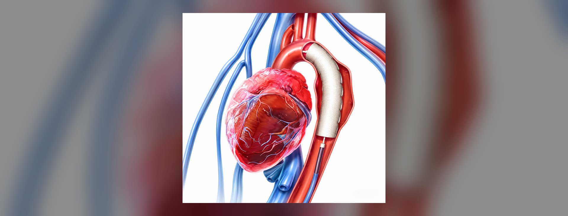 Ilustração de aneurisma da aorta tratado com endoprótese